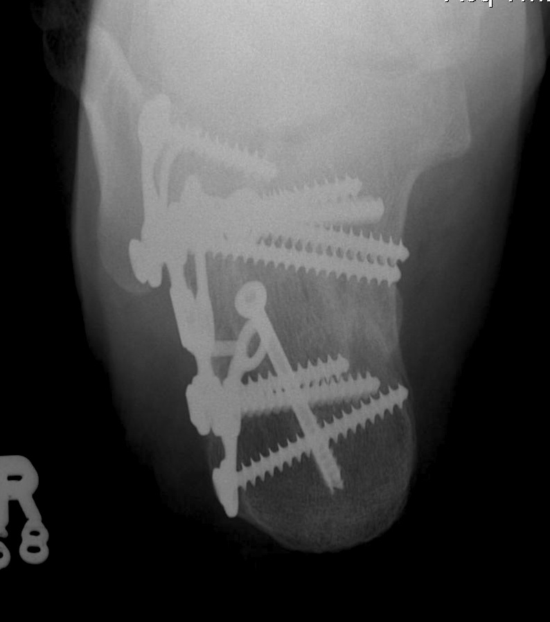 Calcaneal ORIF Axial